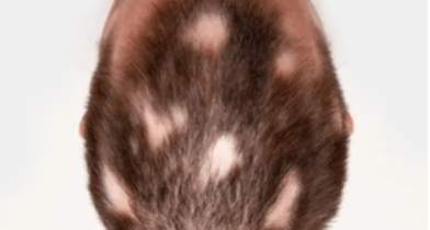 Liečba včelím jedom pre ALOPECIA AREATA