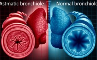 Liečba včelím jedom pri astme