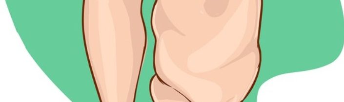 Včelí jed a lymfedém