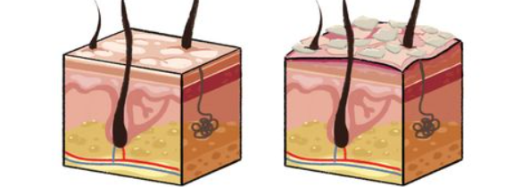 Liečba včelím jedom na Psoriázu